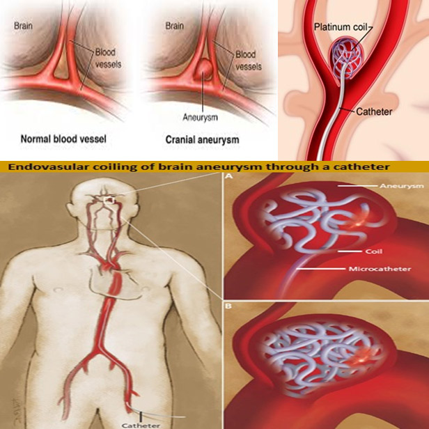 Aneurysm Coiling Surgery in India, Cost of aneurysm coiling surgery in