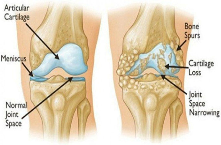Total Knee Replacement Surgery In India