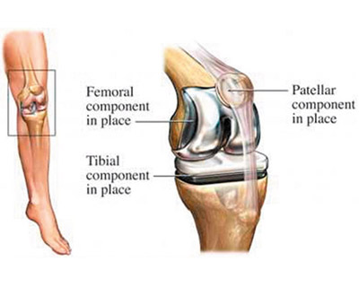 What happens during Total Knee Replacement (TKR)?
