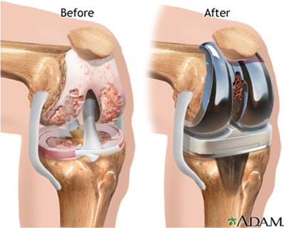 Total Knee Replacement Surgery In India