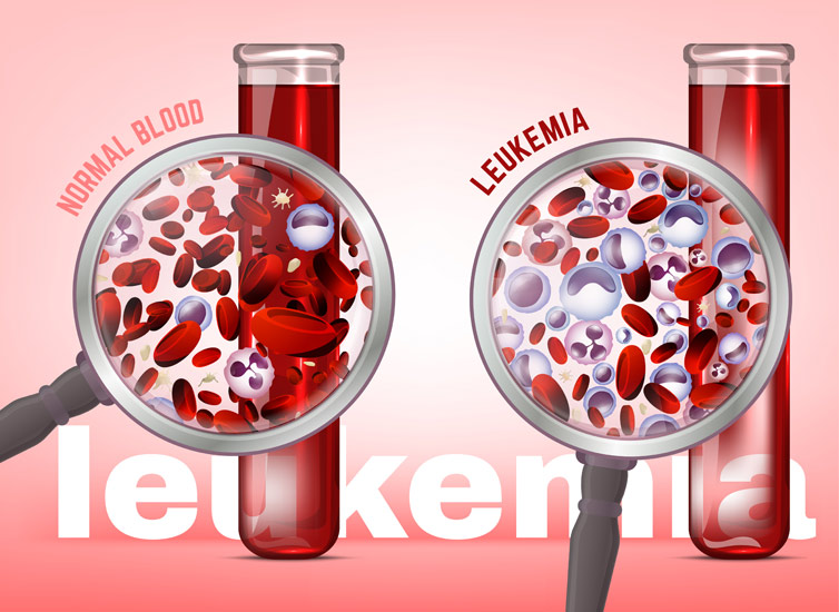 Leukemia (Blood Cancer) Leukemia (Blood Cancer)