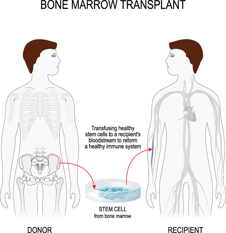 What happens during Bone Marrow Transplant?
