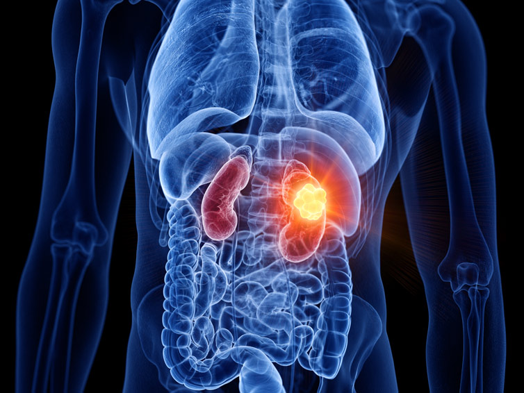 Kidney Cancer Treatment In India