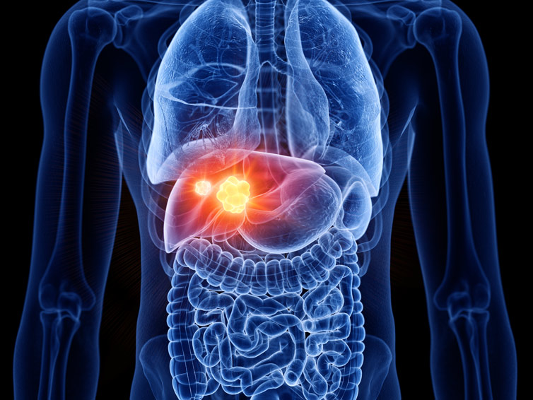 Common Symptoms of Liver Cancer