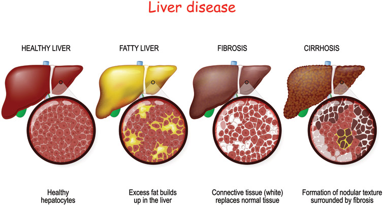 Types of Surgery for Liver Cancer