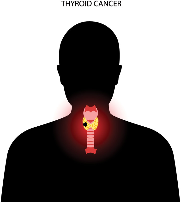 Thyroid Cancer Treatment In India