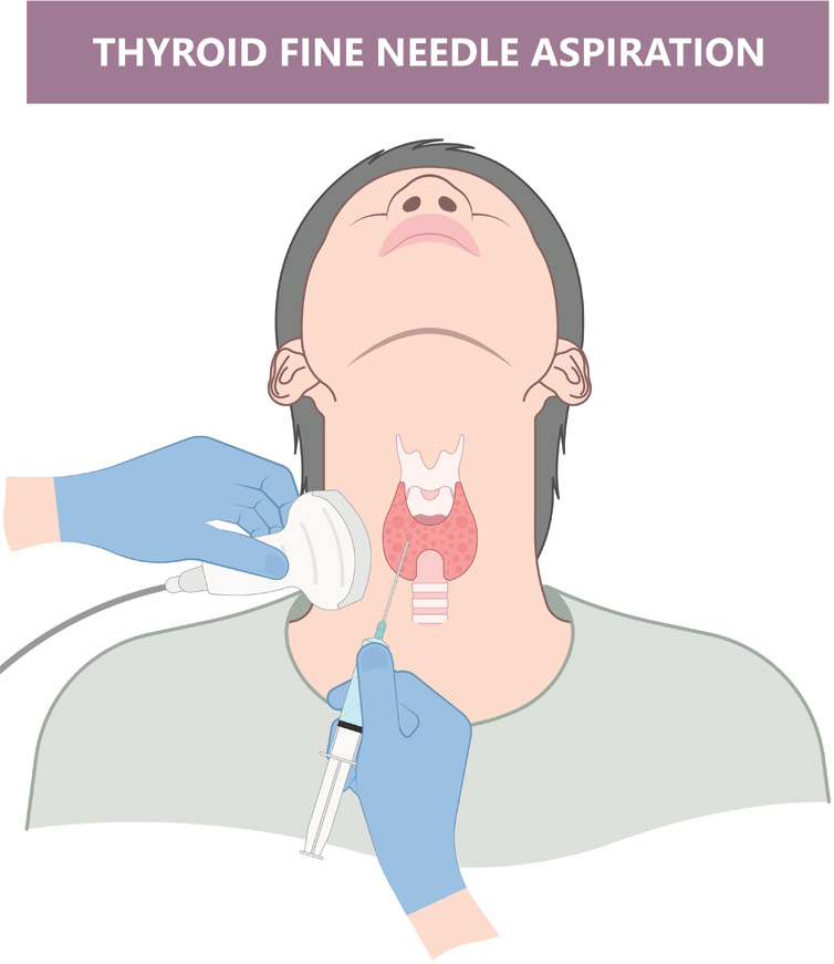 Thyroid Cancer Treatment in India