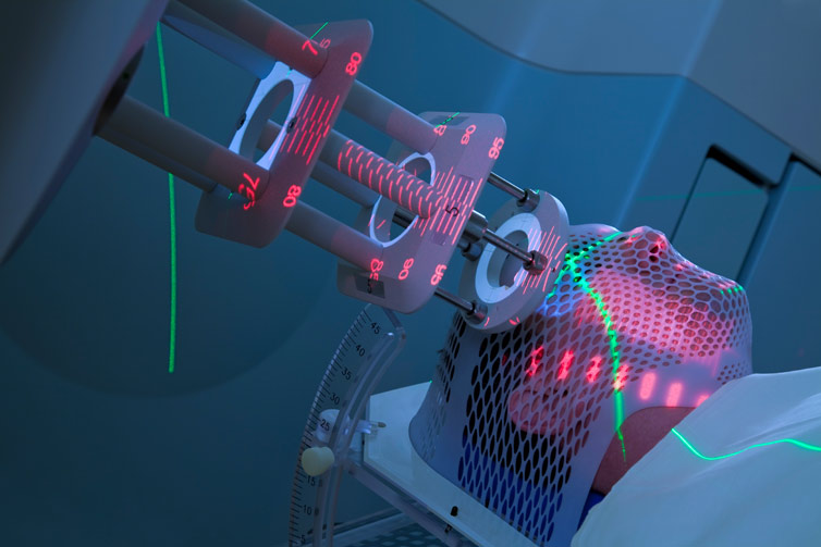 IMRT(Intensity-Modulated Radiation Therapy)