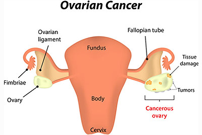 Ovarian Cancer Surgery in India