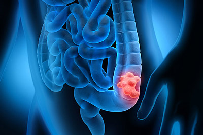 Colon Cancer Treatment in India