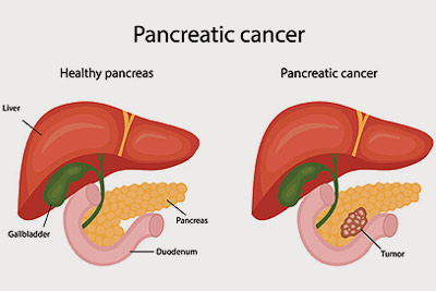 Pancreatic Cancer Surgery in India