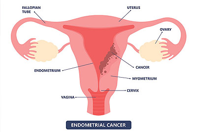 Endometrial Cancer Treatment in India