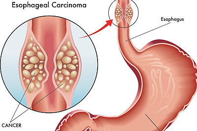 Esophageal Cancer Treatment in India