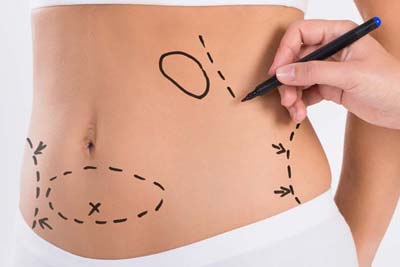 Abdominoplasty Surgery in India