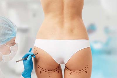 Brazilian Butt Surgery in India