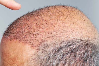 Hair Transplant in India