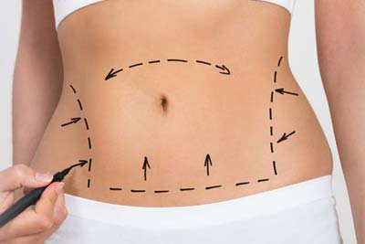 Liposuction Surgery in India