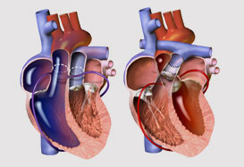 Heart Surgery in India, Best Heart Surgery Hospital in India